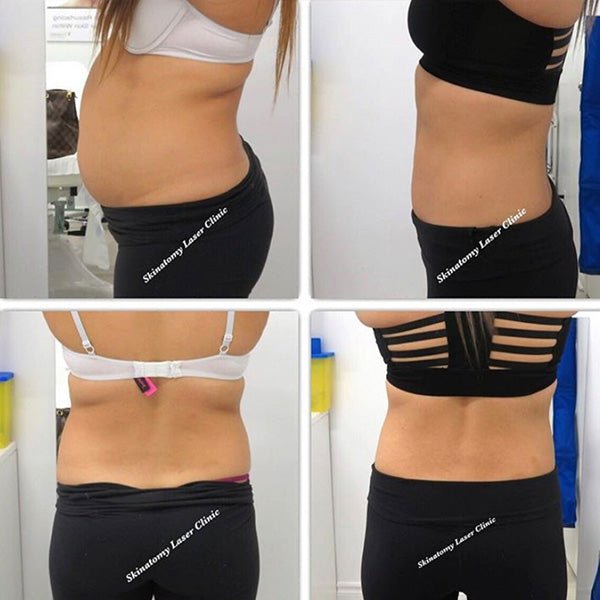 Achieving a Flatter Stomach with Lipolysis Injections