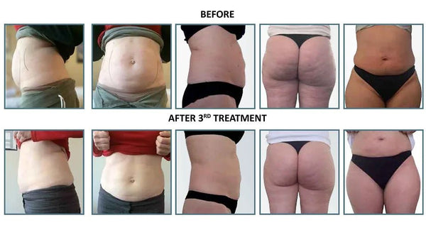 Achieving a Slimmer Figure with Lipo Slimming Injections - Foxy Beauty