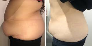 Say Goodbye to Stubborn Fat with Fat Dissolving Injections