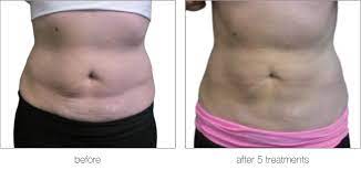 The Benefits of Fat Dissolving Injections - Foxy Beauty