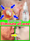 Acne Treatment Serum Korean Skincare Essence
