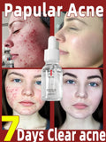 Acne Treatment Serum Korean Skincare Essence